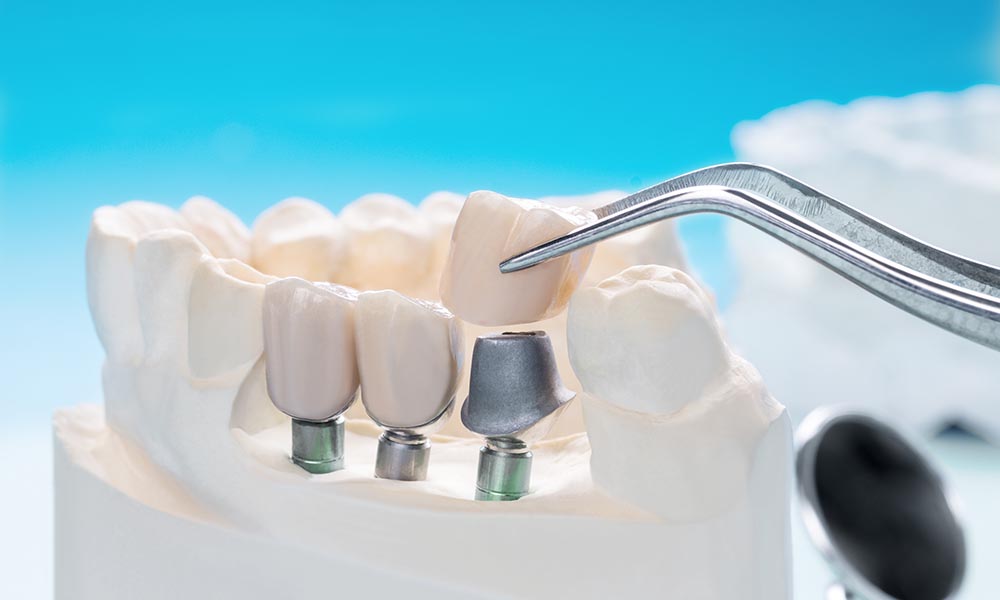 cost of dental bridges