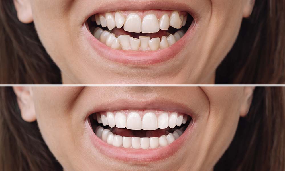 what are veneers