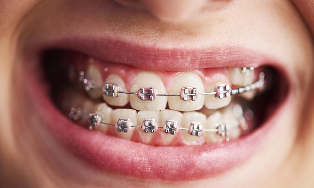 how much do braces cost