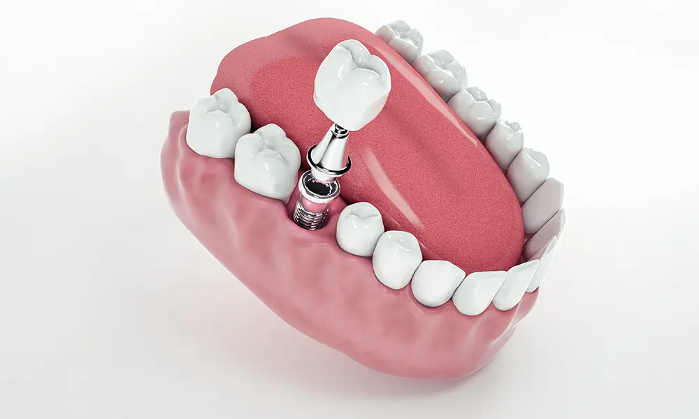 dental implants cost perth,