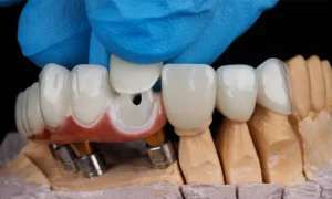 full mouth dental implants,