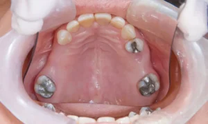 replace silver fillings with white